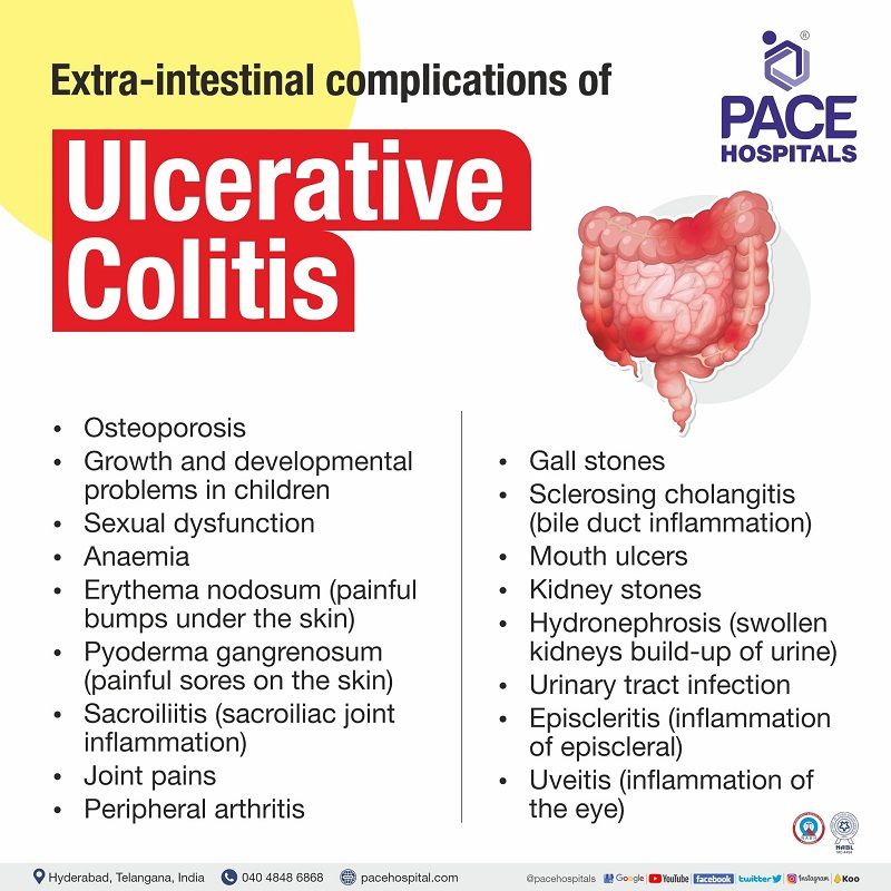 Ulcerative Colitis Symptoms Causes Types And Complications